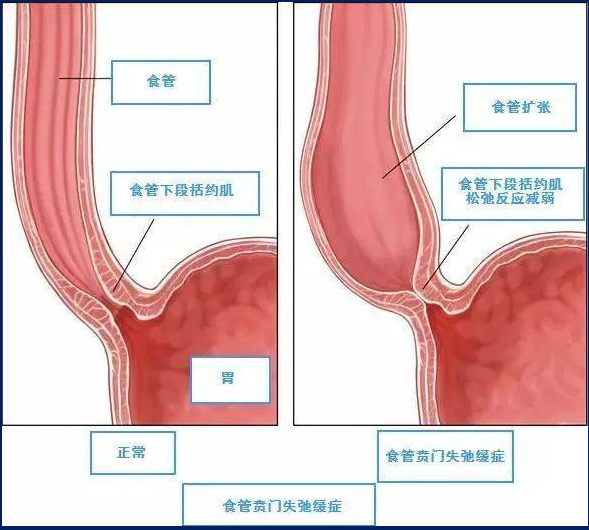 POEM手术：打通经口进食的“生命隧道”