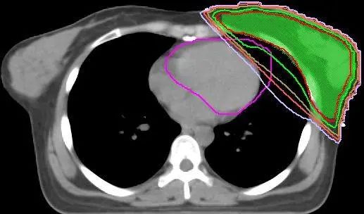 乳腺大分割放疗.jpg