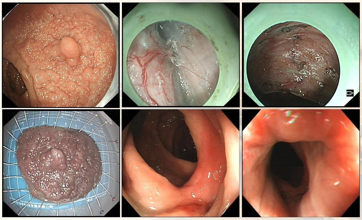 内镜技术进展(1)(1)_39.jpg